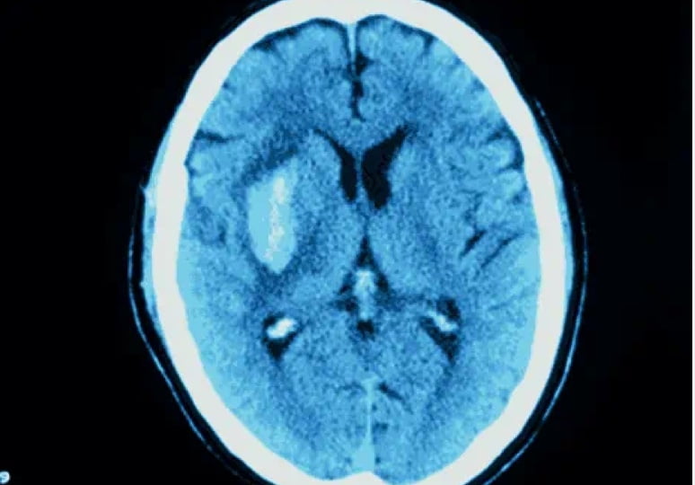 Intracranial hemorrahage