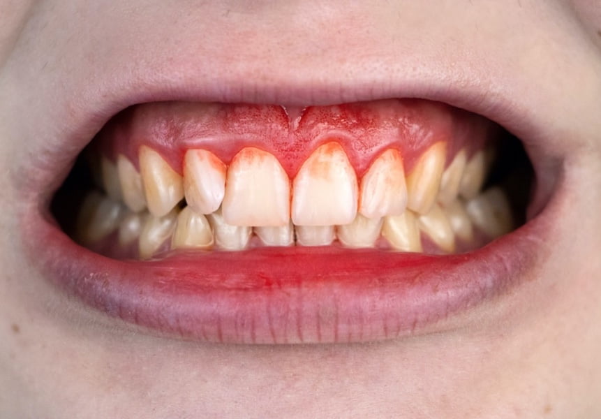 Gum bleeding