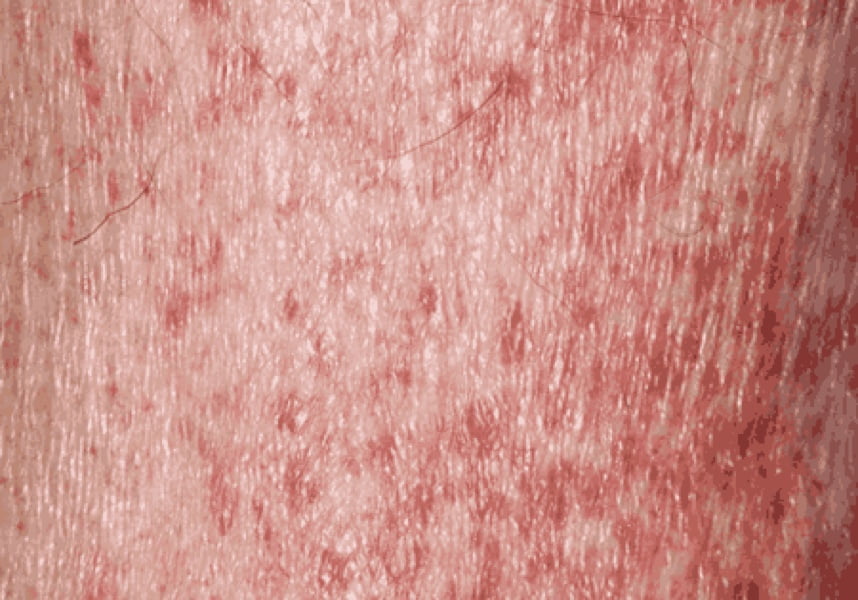 Itp Rash Baby Burden of Disease of ITP | Nplate® (romiplostim)