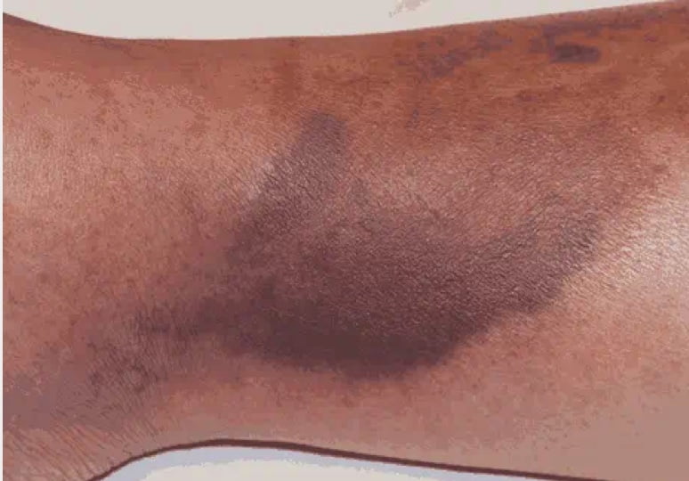 Purpura