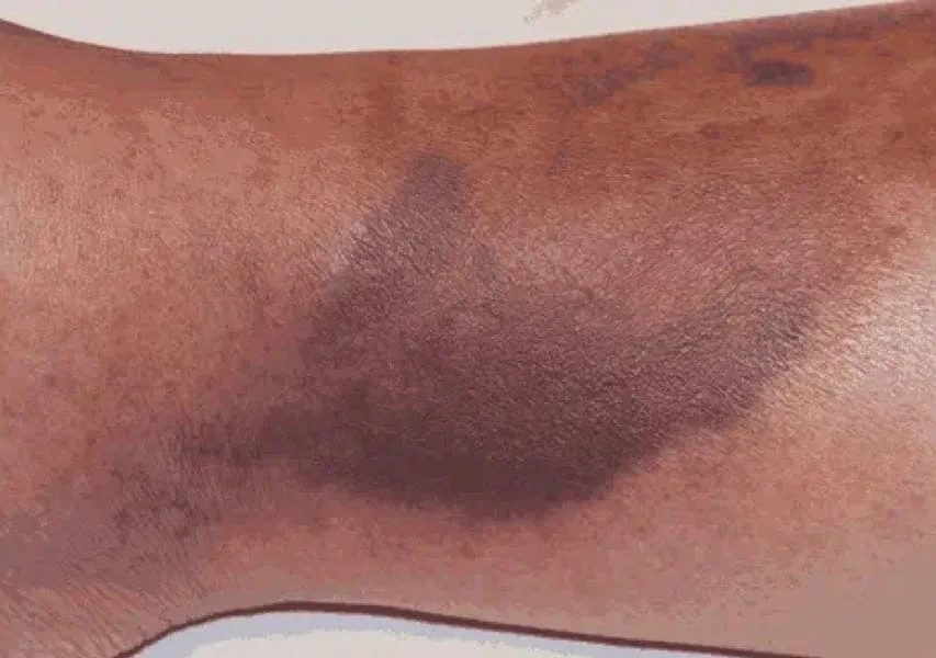 Purpura